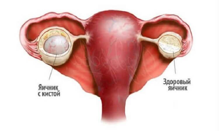 Какие признаки свидетельствуют о наличии патологии яичника