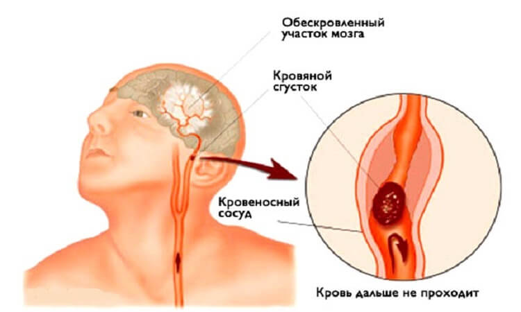 ИНСУЛЬТ: Запомните всего 3 первых шага