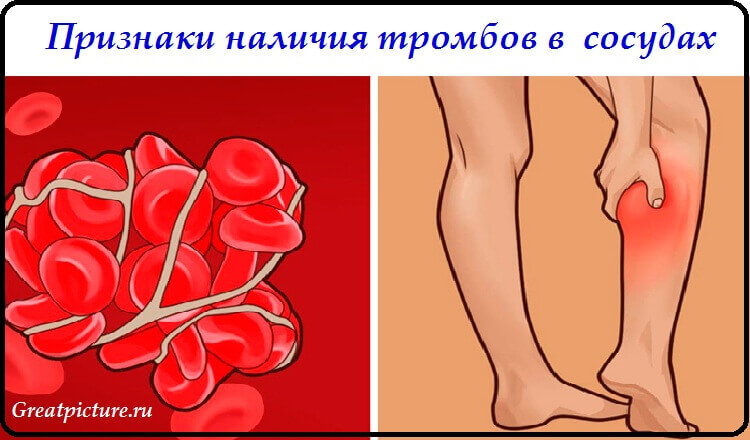 Признаки что у вас появились тромбы в кровеносных сосудах