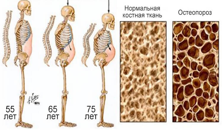 Этот напиток разрушает кости изнутри