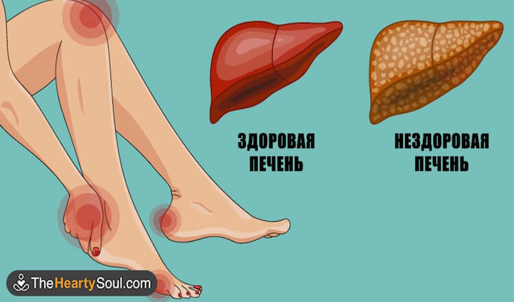 Вот как ваше тело демонстрирует, что ваша печень в опасности