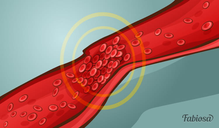 Эти симптомы могут оказаться опасней, чем вы думаете! 6 признаков тромба