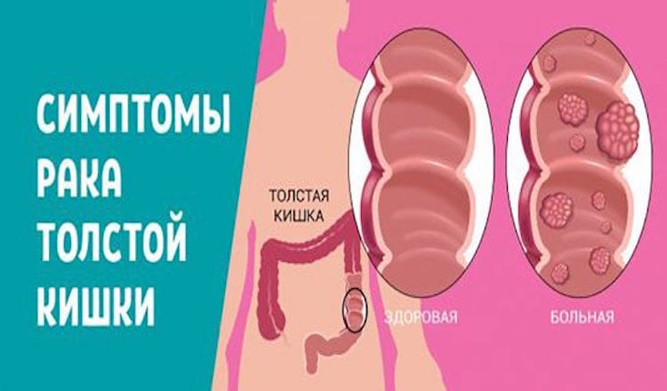 5 тревожных признаков рака толстой кишки. Это важно знать каждому