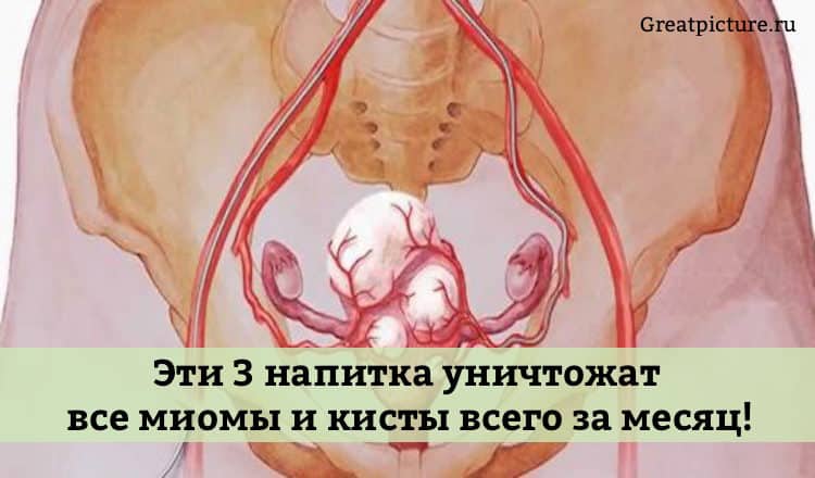 Эти 3 напитка уничтожат все миомы и кисты всего за месяц