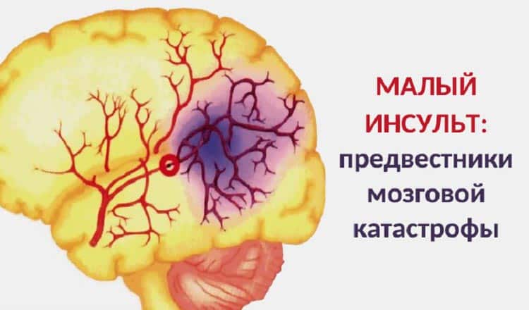 Малый инсульт – предвестники мозговой катастрофы