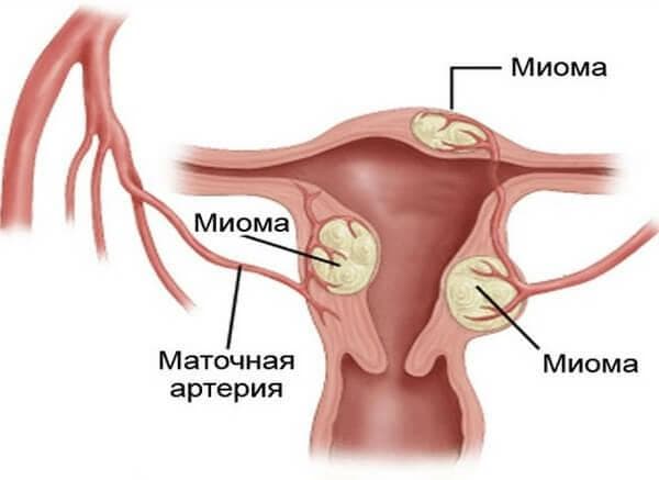 Миома матки: как обойтись без операций и гормональной терапии1