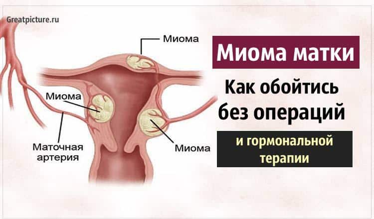 Миома матки: как обойтись без операций и гормональной терапии