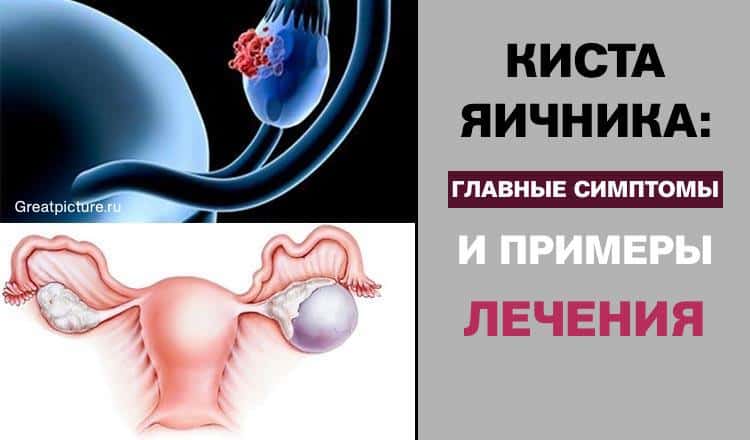 Лечим кисту яичника народными. Симптомы кистомыяичника. Симптомы кичтомы яичника. Киста яичников симптомы.