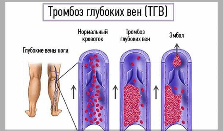 Тромбоз глубоких вен — тихий убийца! 5 ранних симптомов.