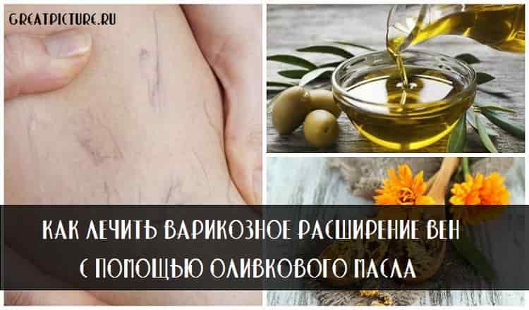 Как лечить варикозное расширение вен с помощью оливкового масла