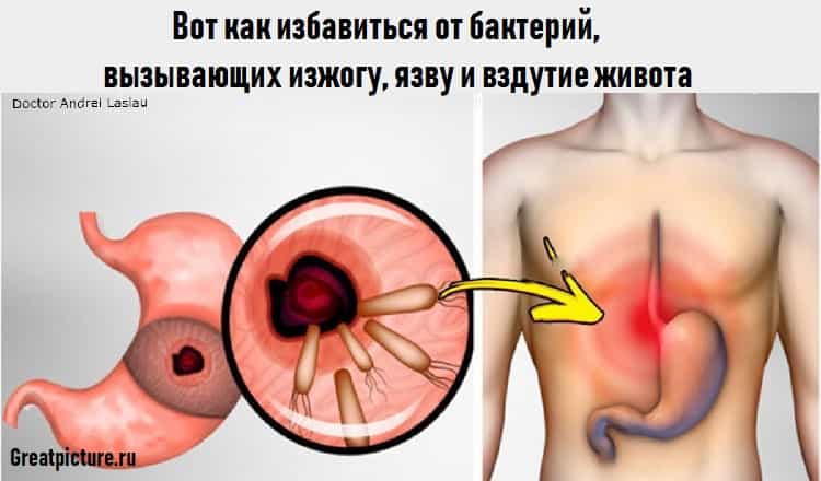 Вот как избавиться от бактерий, вызывающих изжогу, язву и вздутие живота