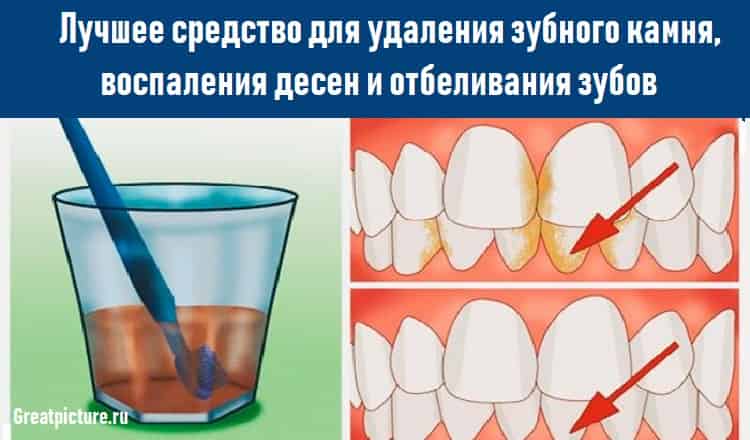 Лучшее средство для удаления зубного камня, воспаления десен и отбеливания зубов