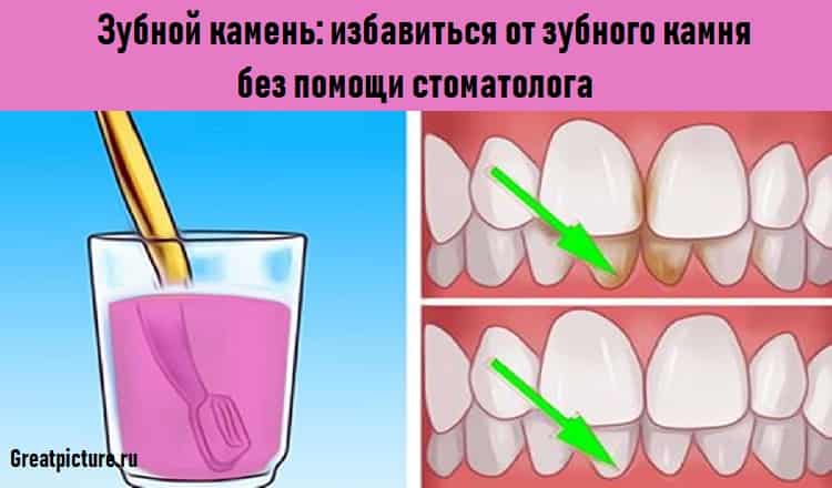 Зубной камень: избавиться от зубного камня без помощи стоматолога