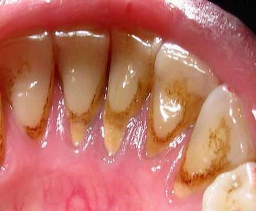 Зубной камень: избавиться от зубного камня без помощи стоматолога