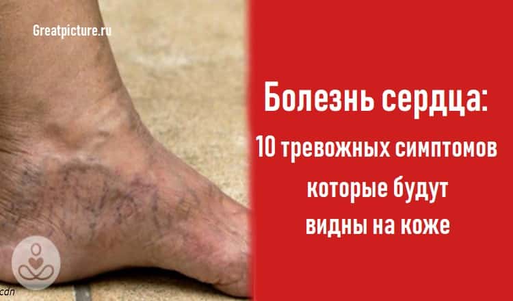 Болезни сердца: 10 симптомов,которые будут видны на коже