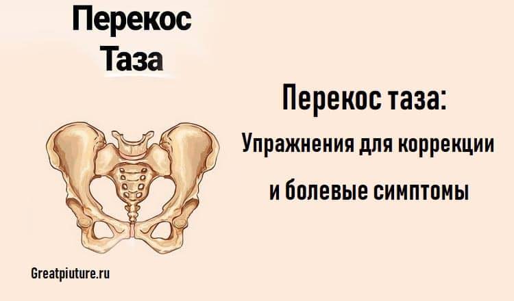 Перекос таза: Упражнения для коррекции и болевые симптомы