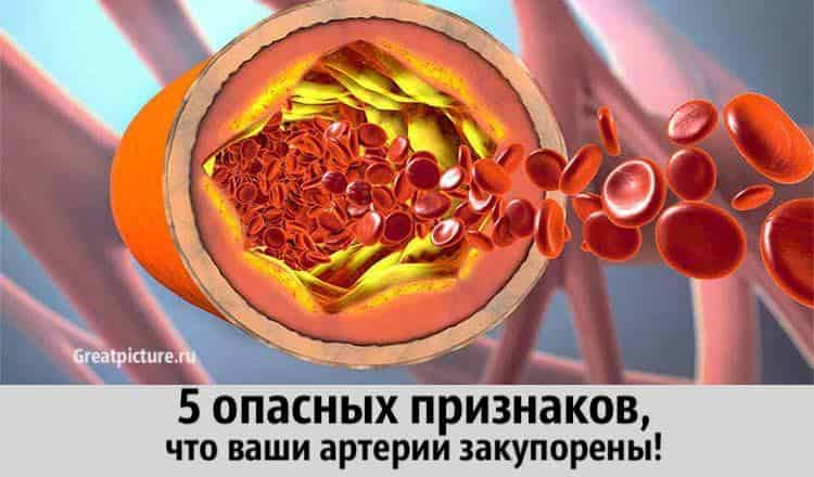 Закупорка артерий. 5 опасных признаков, что ваши артерии закупорены!