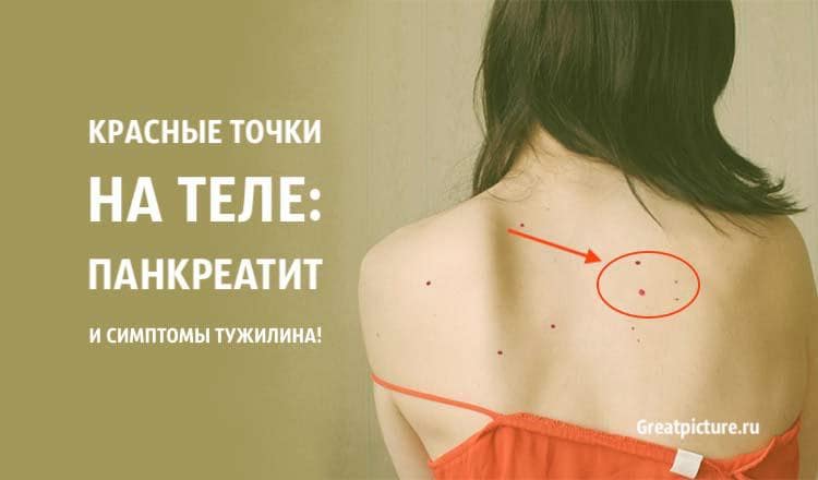 Красные точки на теле: Панкреатит и симптом Тужилина