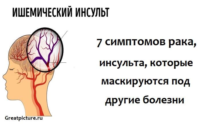 7 симптомов рака, инсульта, которые маскируются под другие болезни