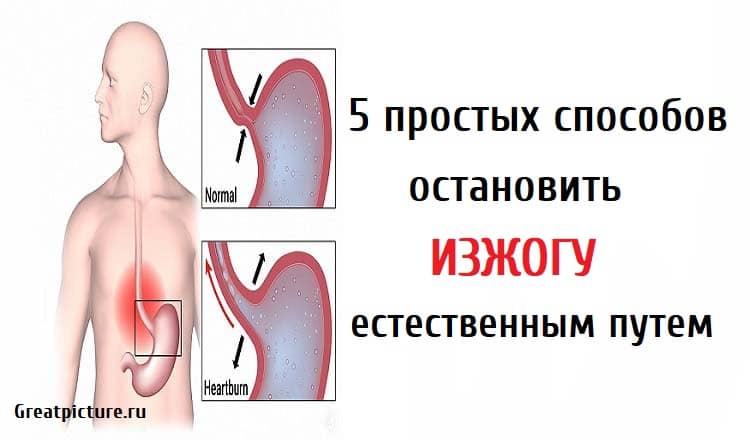 Изжога причины способы устранения у мужчин. Упражнения от изжоги. Изжога способы устранения. Изжога причины.