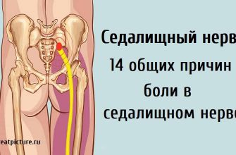 Седалищный нерв: 14 общих причин боли в седалищном нерве