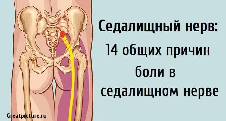 Седалищный нерв: 14 общих причин боли в седалищном нерве