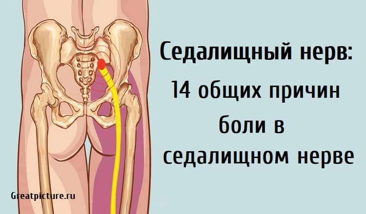 Сильные боли седалищных