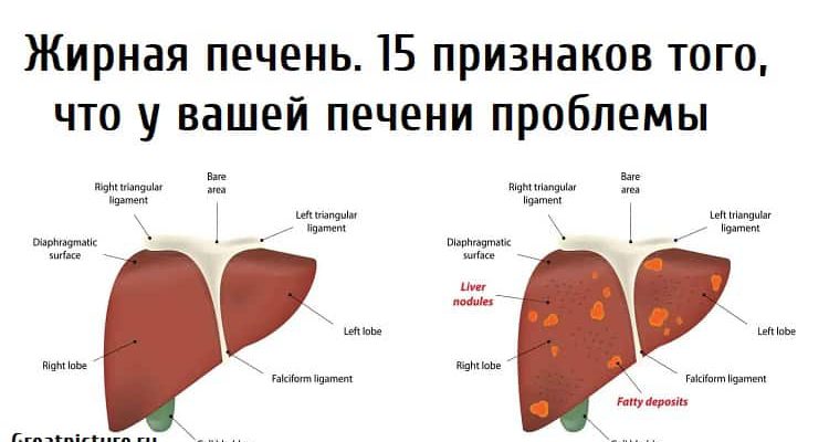 Жирная печень.15 признаков того, что у вашей печени проблемы