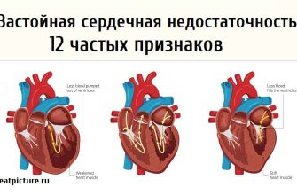 Застойная сердечная недостаточность, 12 частых признаков
