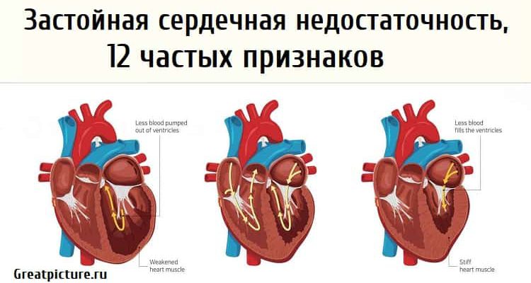 Застойная сердечная недостаточность, 12 частых признаков