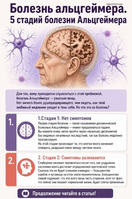 Болезнь альцгеймера