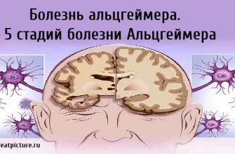 Болезнь альцгеймера.5 стадий болезни Альцгеймера