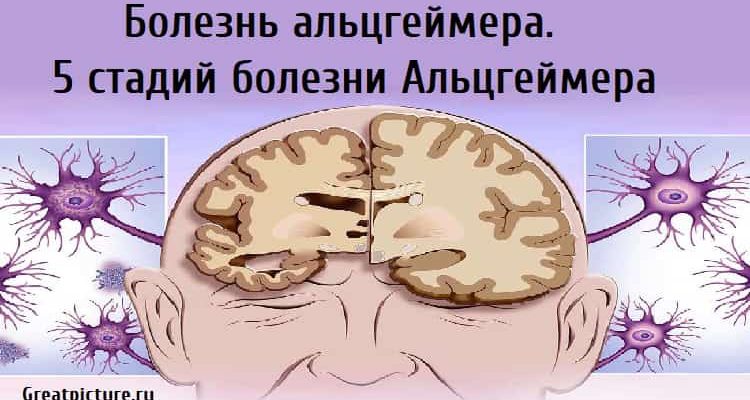 Болезнь альцгеймера.5 стадий болезни Альцгеймера