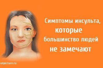 Симптомы инсульта, которые большинство людей не замечают