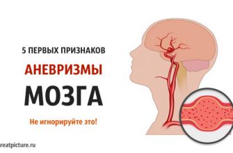 5 первых признаков аневризмы мозга. Не игнорируйте это!