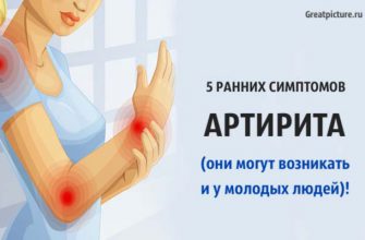 5 ранних симптомов артрита (они могут возникать и у молодых людей)!