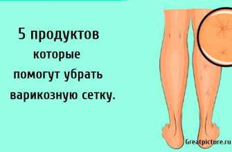 5 продуктов которые помогут убрать варикозную сетку, варикозная сетка, как убрать варикозную сетку,