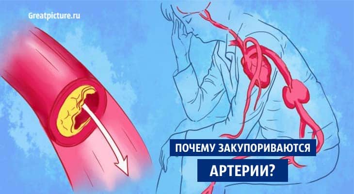 Почему закупориваются артерии